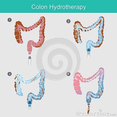 Hydrocolon Therapy